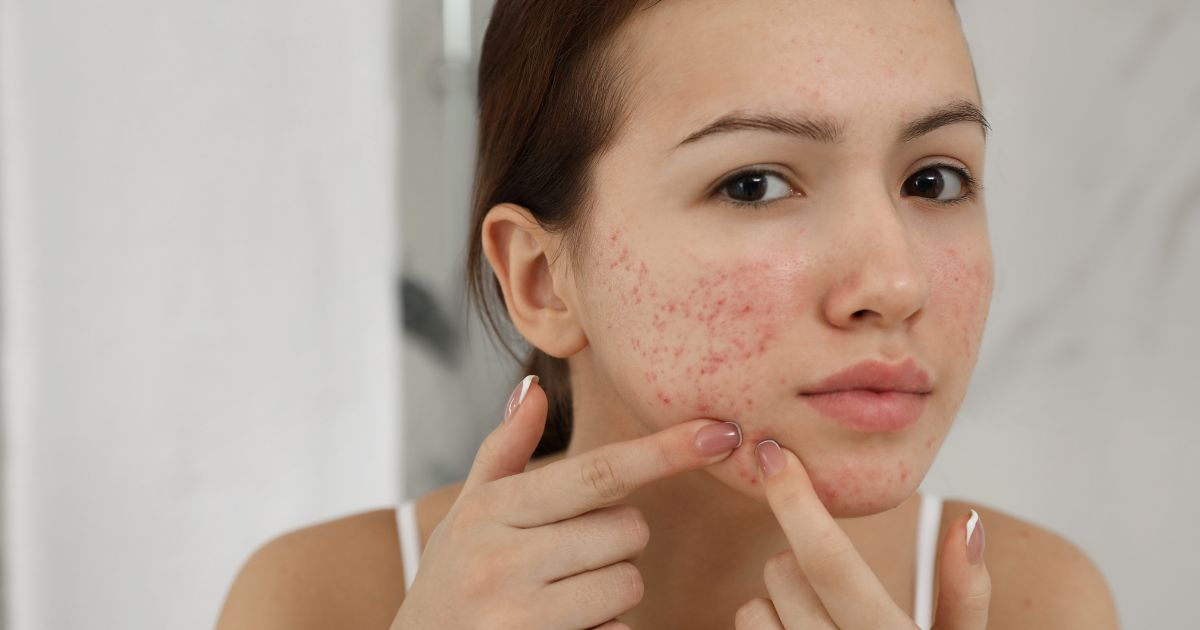 Article Acné : les solutions naturelles des naturopathes