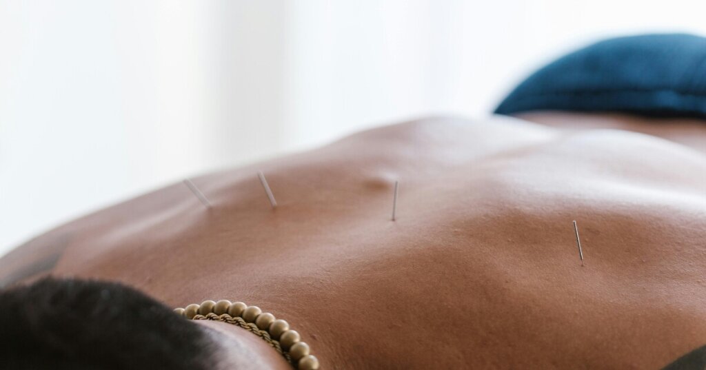 homme qui a des aiguilles d'acupuncture sur le dos